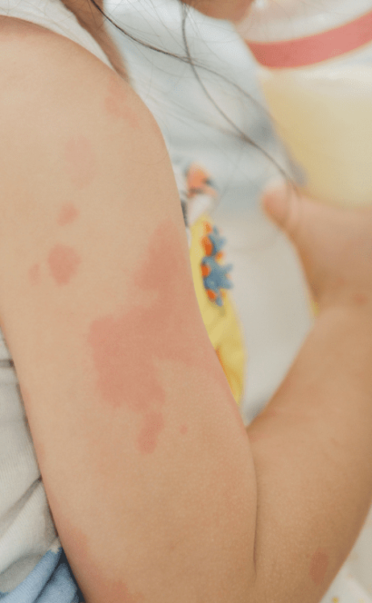 enfant allergique qui a de l'eczema